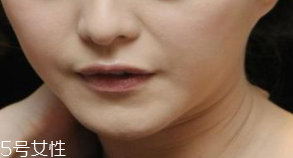 頸紋是怎么產(chǎn)生的？比面部肌膚更加脆弱
