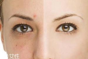 祛痘產(chǎn)品怎么選？先要分清痘印類型