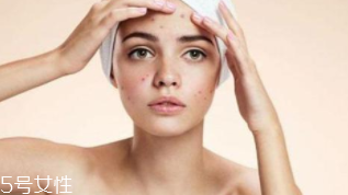 祛痘產(chǎn)品怎么選？先要分清痘印類型