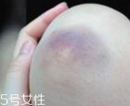 身體淤青怎么來的？不是磕碰那么簡單