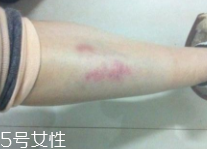 身體淤青怎么來的？不是磕碰那么簡單
