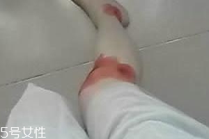 摔傷了涂什么藥好的快？做好消毒才能愈合快