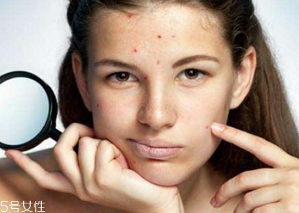 激光去痘印會(huì)留疤嗎？不規(guī)范操作肯定會(huì)有疤