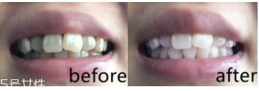 美白牙膏有用嗎？中華魔麗迅白牙膏評(píng)測(cè)