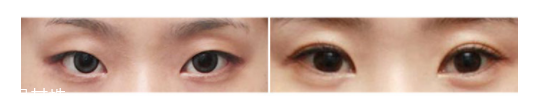 下眼瞼整形手術(shù)會(huì)留疤嗎？一般無(wú)明顯疤痕