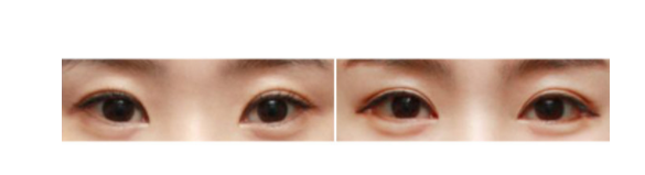 下眼瞼整形手術(shù)會(huì)留疤嗎？一般無(wú)明顯疤痕