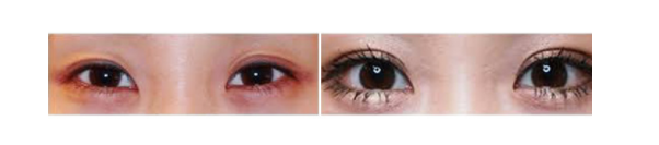 下眼瞼整形手術(shù)會(huì)留疤嗎？一般無(wú)明顯疤痕