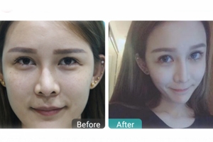 下瞼整形多久能恢復自然？半年時間