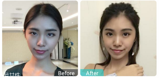 下瞼整形多久能恢復(fù)自然？半年時間