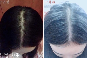 柳屋生發(fā)水有用嗎？一個(gè)月后長(zhǎng)出新發(fā)