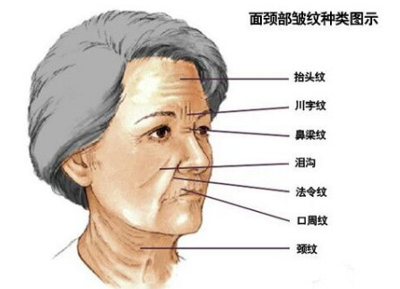 川字紋可以打玻尿酸嗎？不是最佳選擇