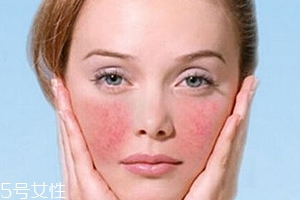 紅血絲用哪種護膚品？6款大牌全面對抗紅血絲