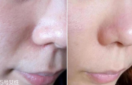 aesop伊索祛痘凝膠怎么樣？一晚還你平滑肌膚