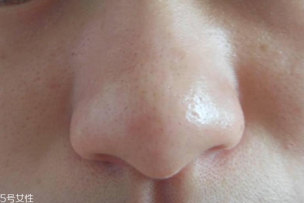 去黑頭用什么最有效？徒手擠黑頭容易感染