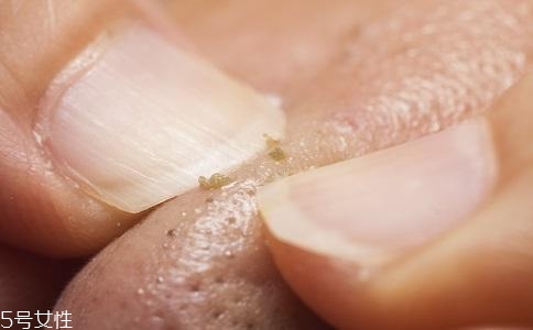 去黑頭用什么最有效？徒手擠黑頭容易感染