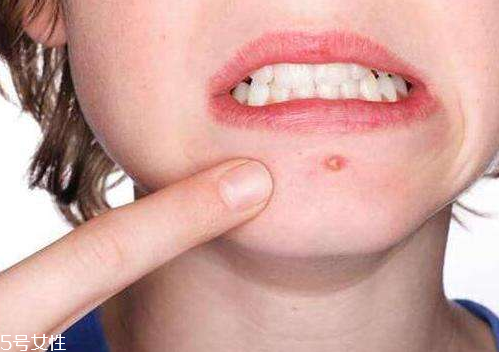 skinb5抗痘護(hù)膚片有效果嗎？