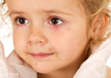 痘印顏色加深是怎么回事？補(bǔ)水還不夠