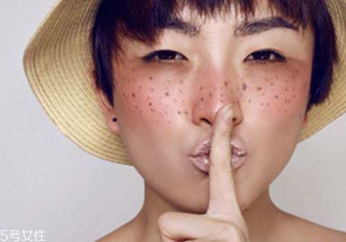 祛斑反彈是什么原因？一定沒注意這4點