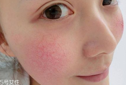 紅血絲用什么顏色的隔離好 紅血絲自然消除法 紅血絲用什么顏色的隔離好 紅血絲自然消除法