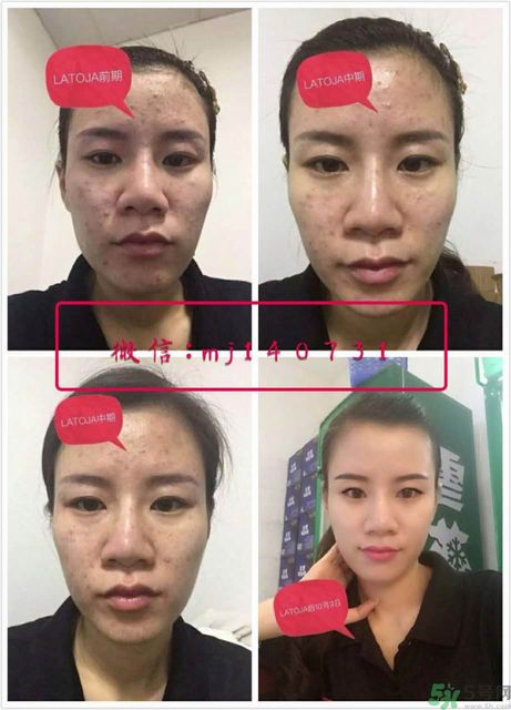 涵曦排毒針效果怎么樣？涵曦新品排毒針安全有副作用嗎？