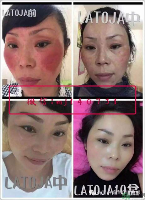 涵曦排毒針效果怎么樣？涵曦新品排毒針安全有副作用嗎？