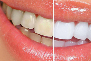 牙貼可以每天用嗎？牙貼多久用一次