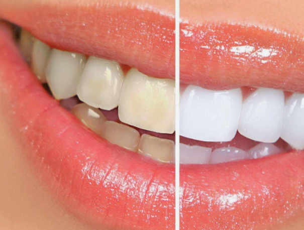 牙貼可以貼著睡覺嗎？牙貼可以過夜嗎