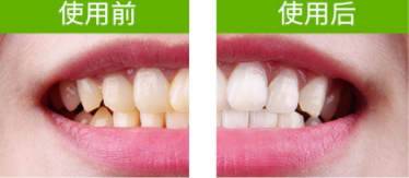 牙貼怎么分上下牙貼？牙貼怎么分正反