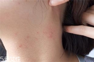 脖子長痘痘怎么辦 教你脖子護(hù)理方法 脖子長痘痘怎么辦 教你脖子護(hù)理方法