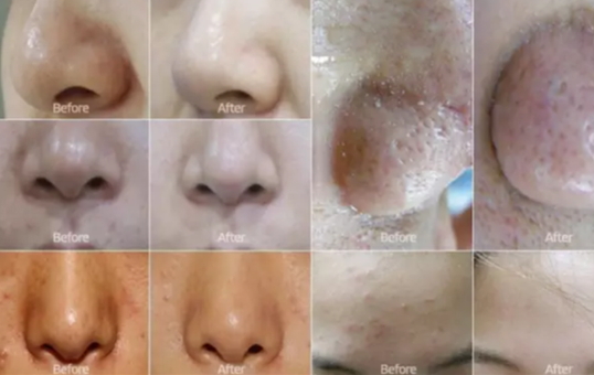 弄完小氣泡多久可以化妝？小氣泡注意事項(xiàng)