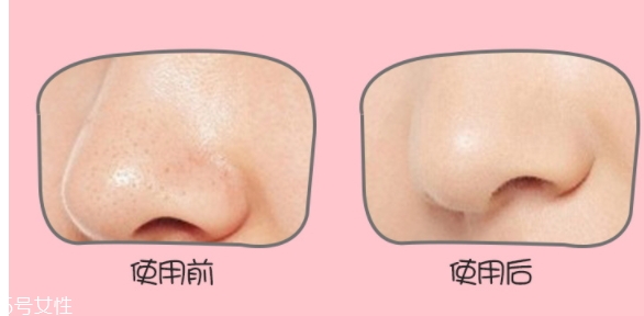 yoii黑頭儀怎么用？yoii黑頭儀怎么充電