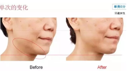 雅萌射頻美容儀防水嗎？雅萌Bloom射頻美容儀可以水洗嗎