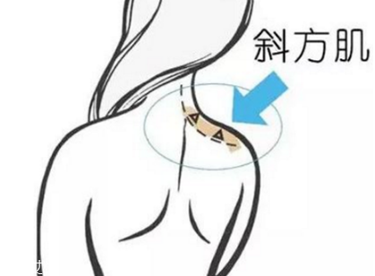 瘦肩針間隔多久打一次？打瘦肩針間隔時(shí)間