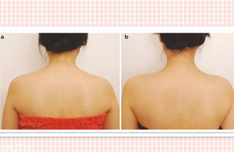 瘦肩針可以緩解疲勞嗎？瘦肩針對緩解疲勞有用嗎