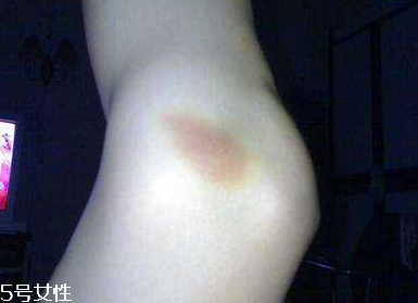 小林制藥去淤青膏怎么樣？小林制藥去淤青膏好用嗎？