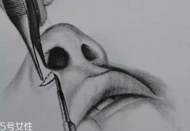 鼻翼外切多久消腫？鼻翼外切消腫時間要多長？