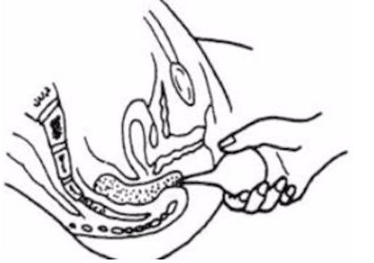 開塞露躺著還是蹲著用？開塞露使用姿勢