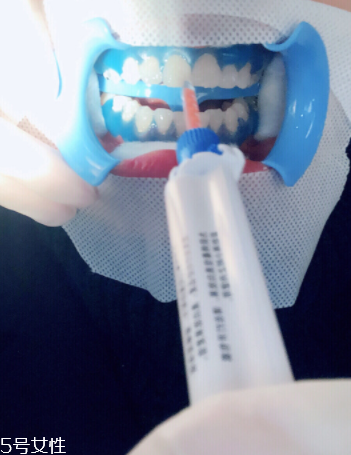 冷光美白會反彈嗎？冷光美白心得