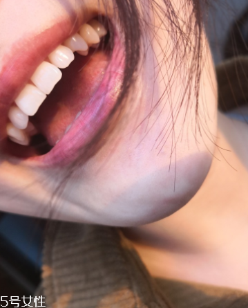 超聲波潔牙牙齒會(huì)變白嗎？超聲波潔牙心得