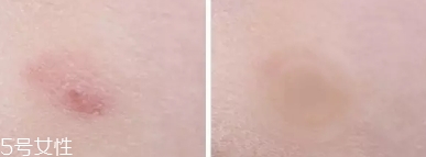 vt痘痘貼怎么用？vt老虎痘痘貼防水嗎