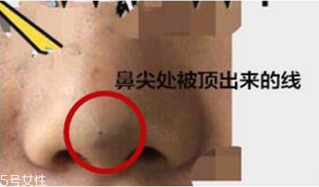 線(xiàn)雕隆鼻存在哪些危害 線(xiàn)雕隆鼻有危害嗎