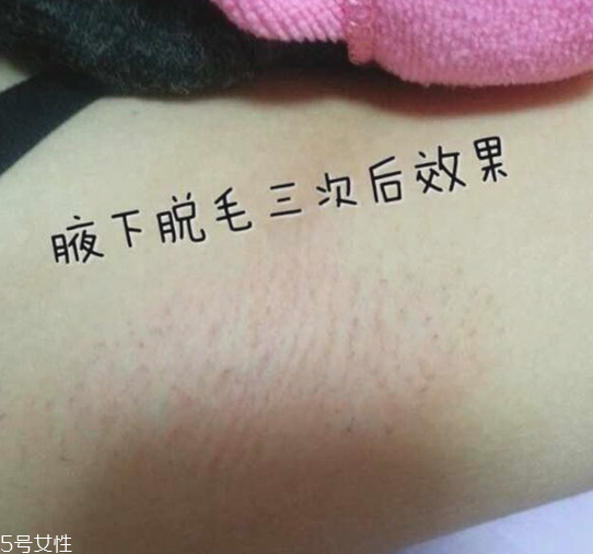 雅萌脫毛儀閃燈次數(shù)是多少 雅萌脫毛儀的使用壽命 雅萌脫毛儀閃燈次數(shù)是多少 雅萌脫毛儀的使用壽命