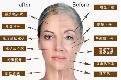 愛(ài)貝芙隆鼻要打幾次？愛(ài)貝芙隆鼻需要打幾針