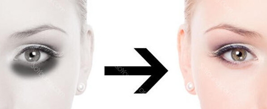 激光去黑眼圈多久恢復？激光除黑眼圈多久見效