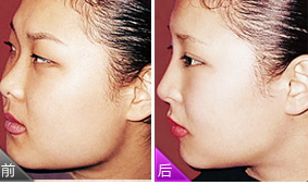 腫眼泡吸脂多少錢？腫眼泡吸脂做幾次