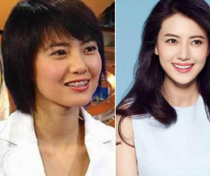 牙齒矯正會(huì)改變臉型嗎？矯正牙齒臉型變化圖