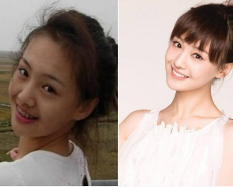 牙齒矯正會(huì)改變臉型嗎？矯正牙齒臉型變化圖