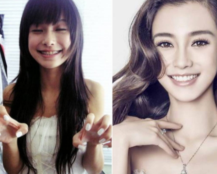 牙齒矯正會(huì)改變臉型嗎？矯正牙齒臉型變化圖