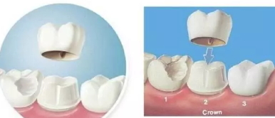 美容冠多少錢一顆？美容冠矯正費用