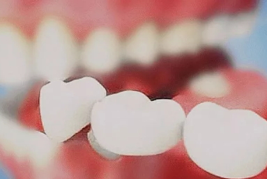 美容冠多少錢一顆？美容冠矯正費用